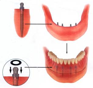 Mini Implant retained Dentures