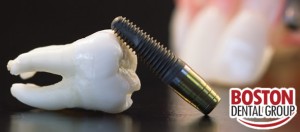 dental implants up close