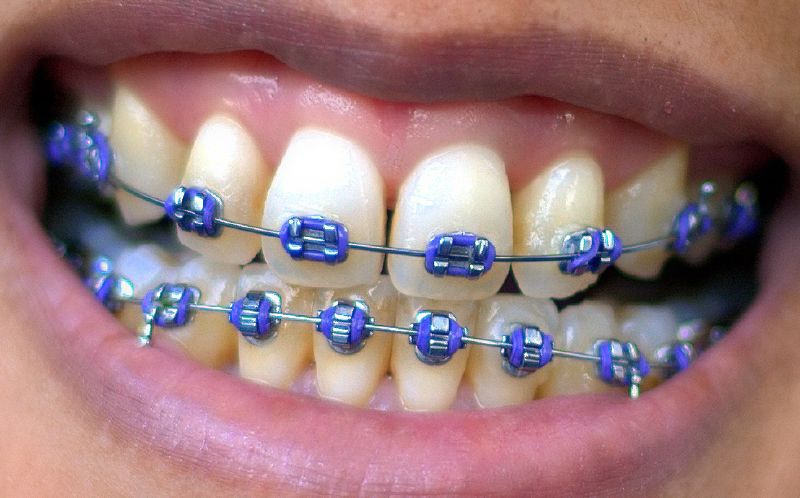 color braces