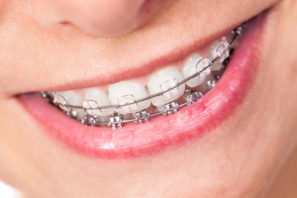 consult an orthodontists to see if adult braces are right for you