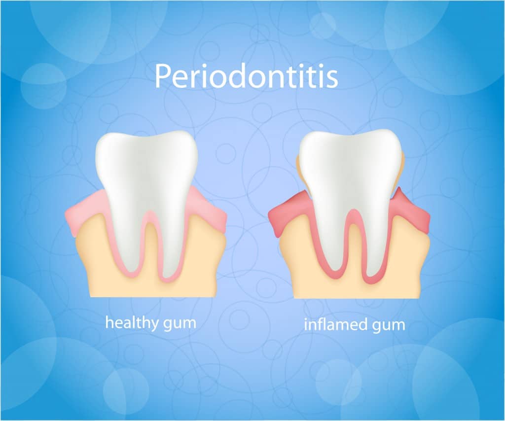 how to tell if you have gum disease