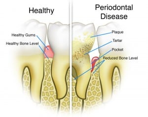 a dentist in Summerlin can treat gum disease