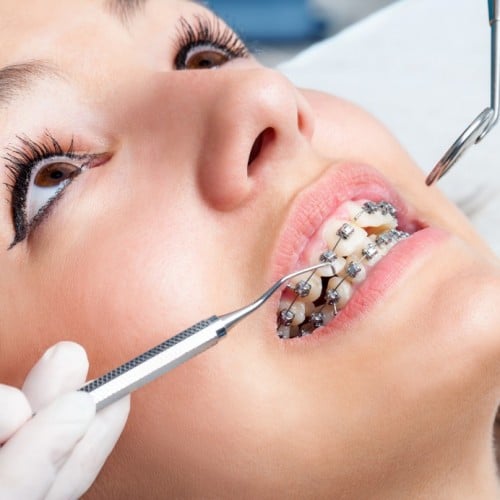 Clip in Braces for Teeth: Everything You Need to Know - Now Aesthetic