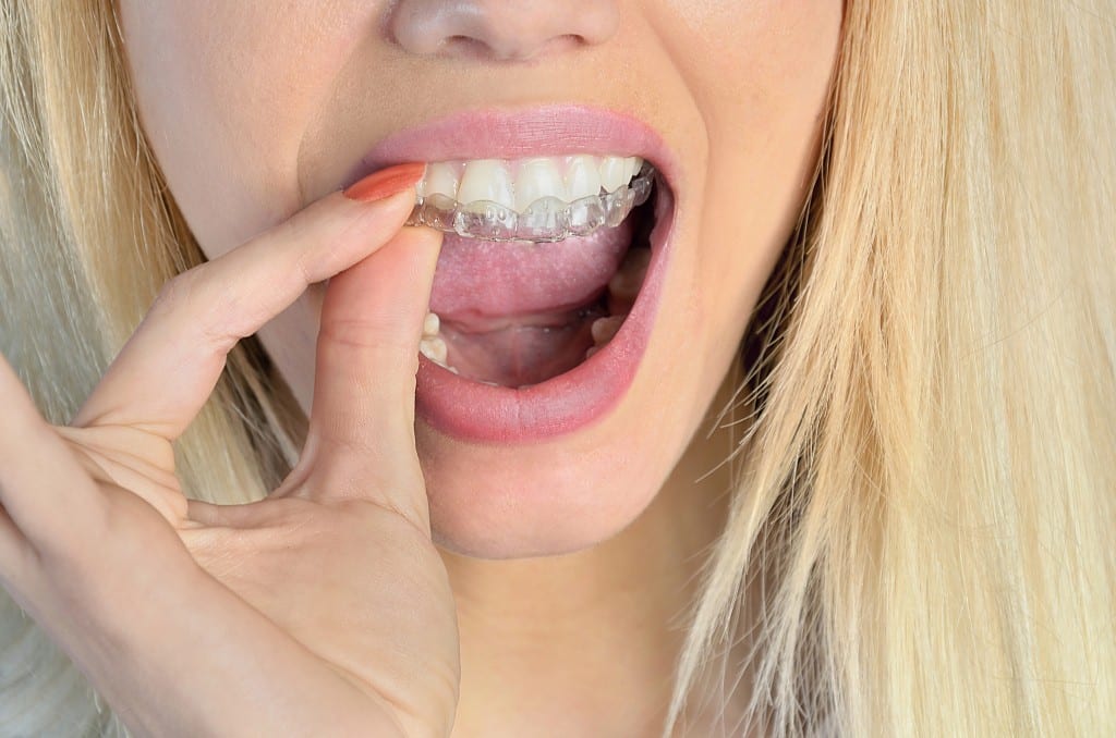 Women using a clear retainer or mouth guard