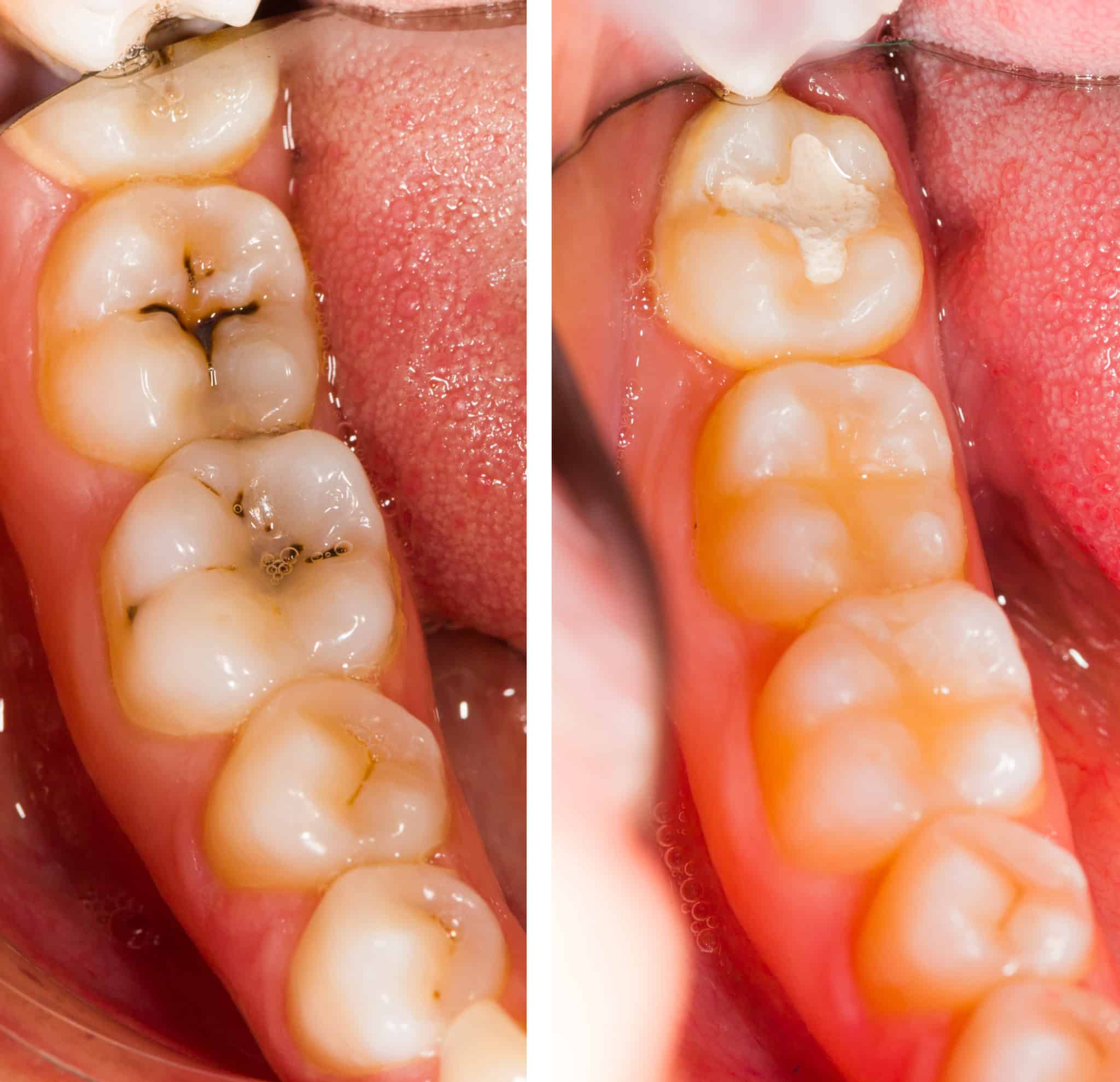 Teeth with cavities and fillings