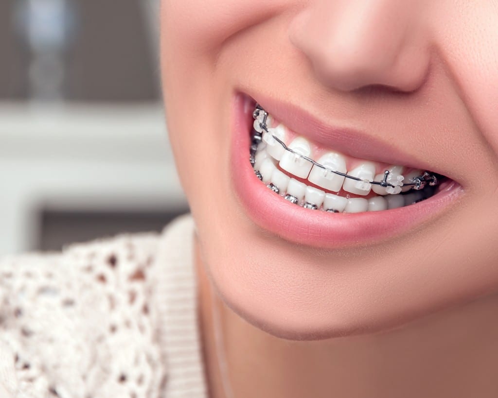 Young woman smiling with braces