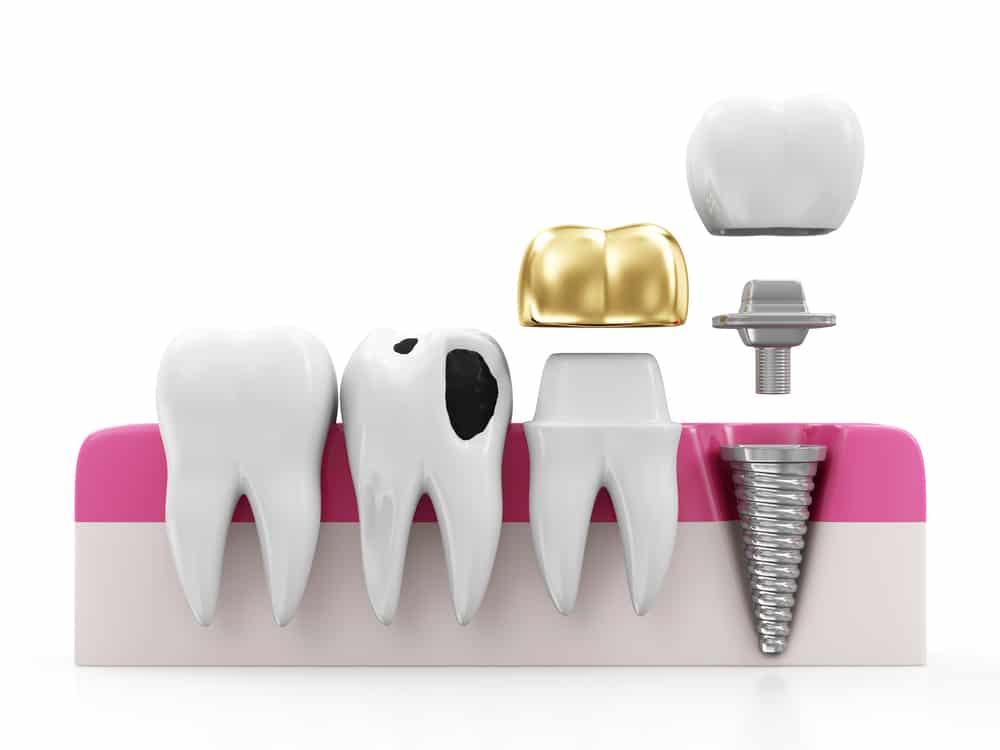Dental Crown infographic