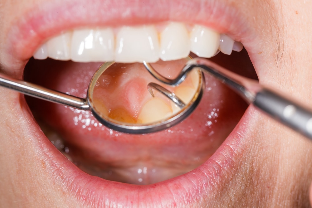 Dentist examining mouth