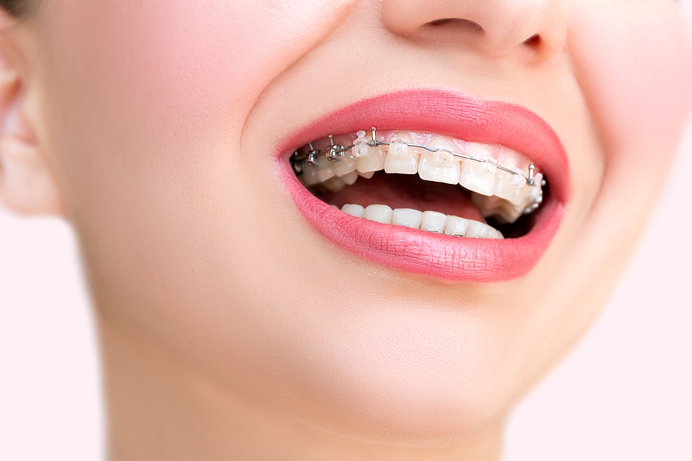 woman with braces smiling after visiting an orthodontist in las vegas