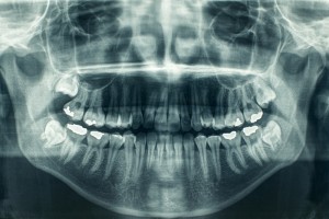 How to Fix an Overbite: Causes and Corrections - BDG