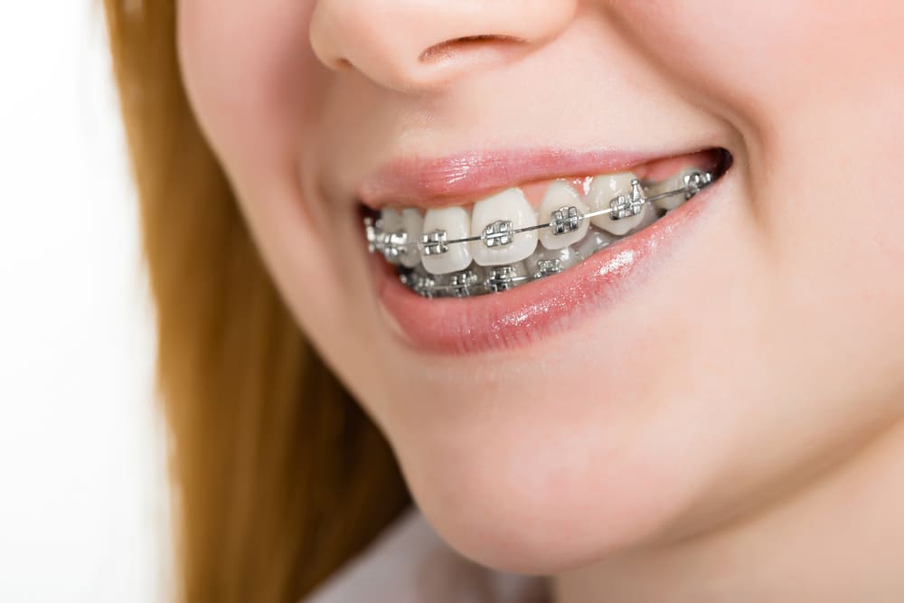 young woman with braces in las vegas