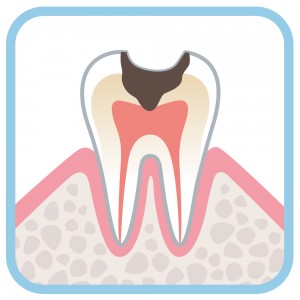 Illustration of a tooth with a cavity