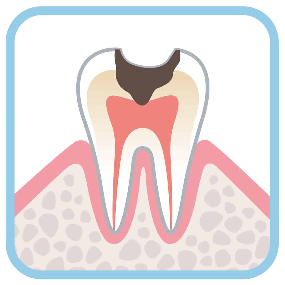 Illustration of a tooth with a cavity