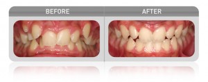 Myofunctional Device Crowding Case - Las Vegas Dentists