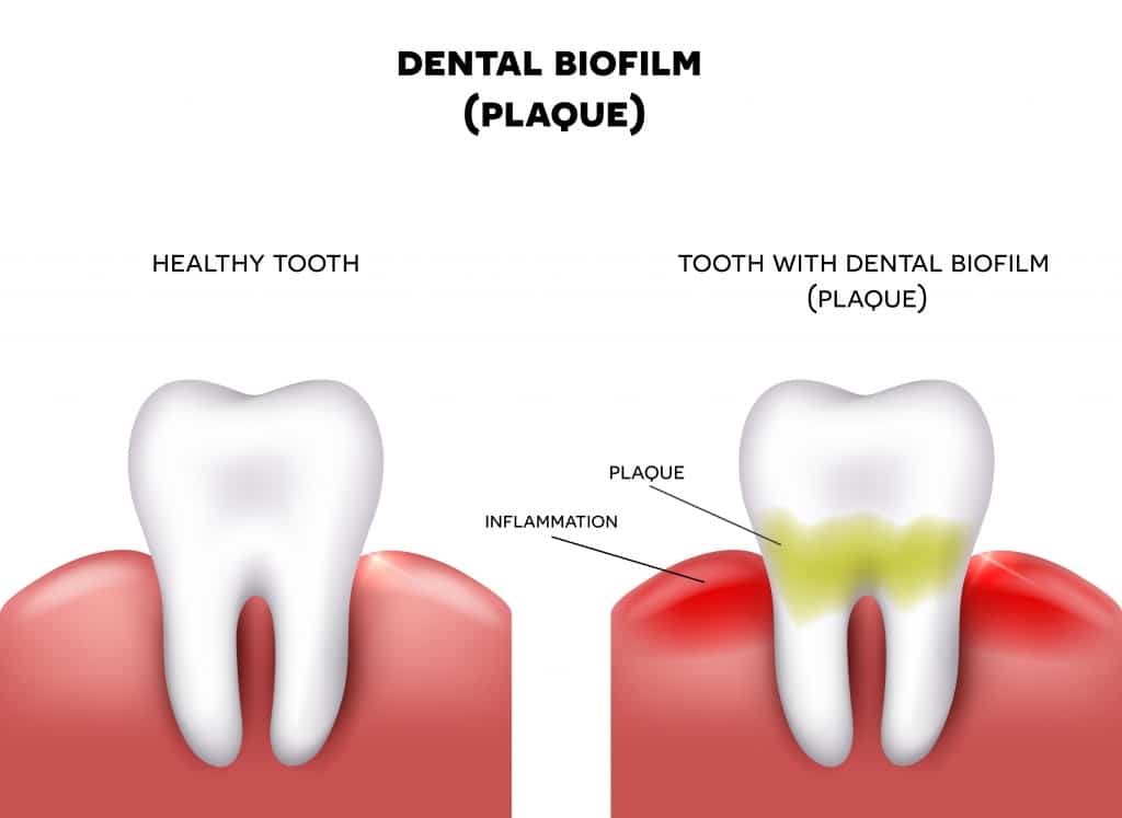 4 Techniques Dentists Use to Remove Plaque and Tartar