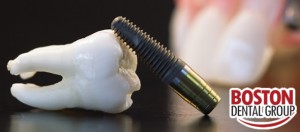 Dental Implants