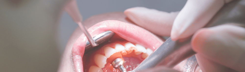 warning signs of periodontal disease 