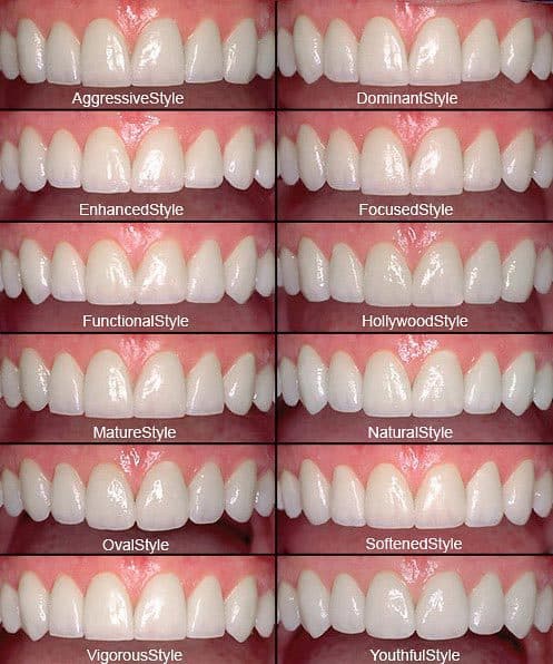 porcelain veneers