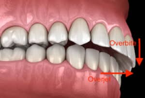 what is an overbite