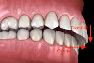 What is an Overbite, Exactly? How to Treat It?