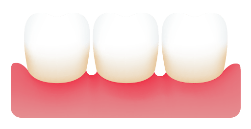 Advanced Periodontitis