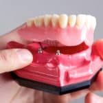 snap in dentures vs traditional dentures