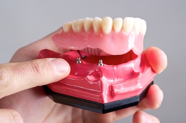 snap in dentures vs traditional dentures