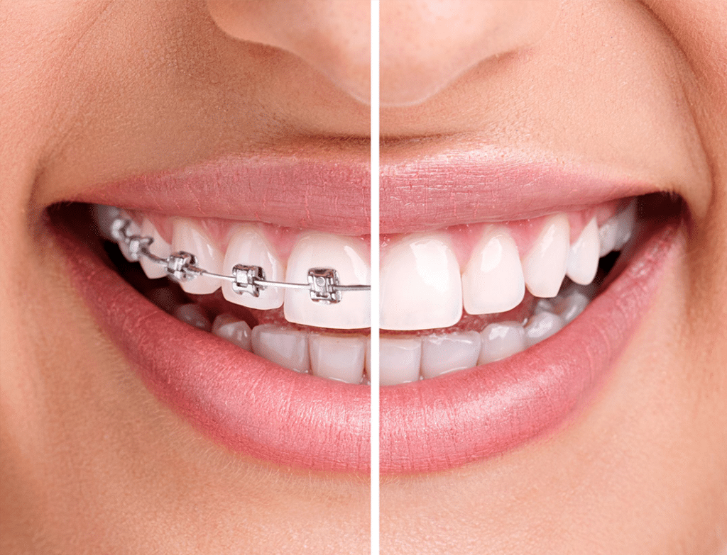 Braces or Invisalign