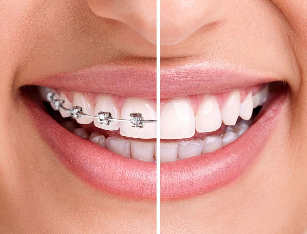 Las Vegas Orthodontics - Braces & Invisalign