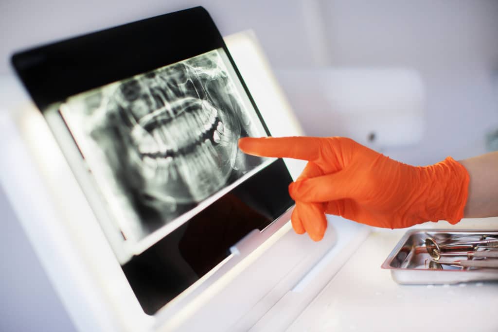 are dental implants worth the investment