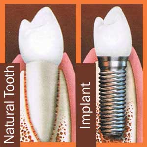 Dental Implants Las Vegas