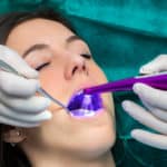 dental sealants