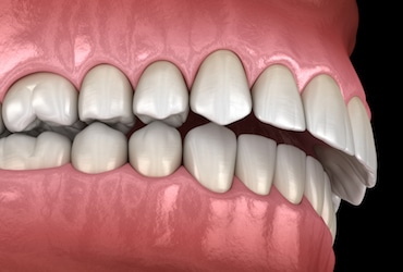 how to fix an overbite