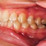 how to treat swollen or receding gums