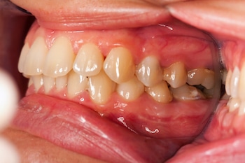 how to treat swollen or receding gums