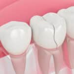 cracked tooth syndrome