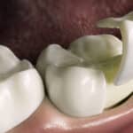 dental bonding