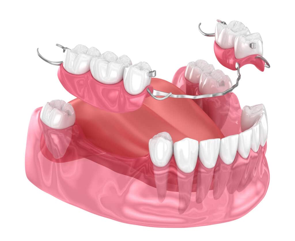 how do dentures work? partial dentures