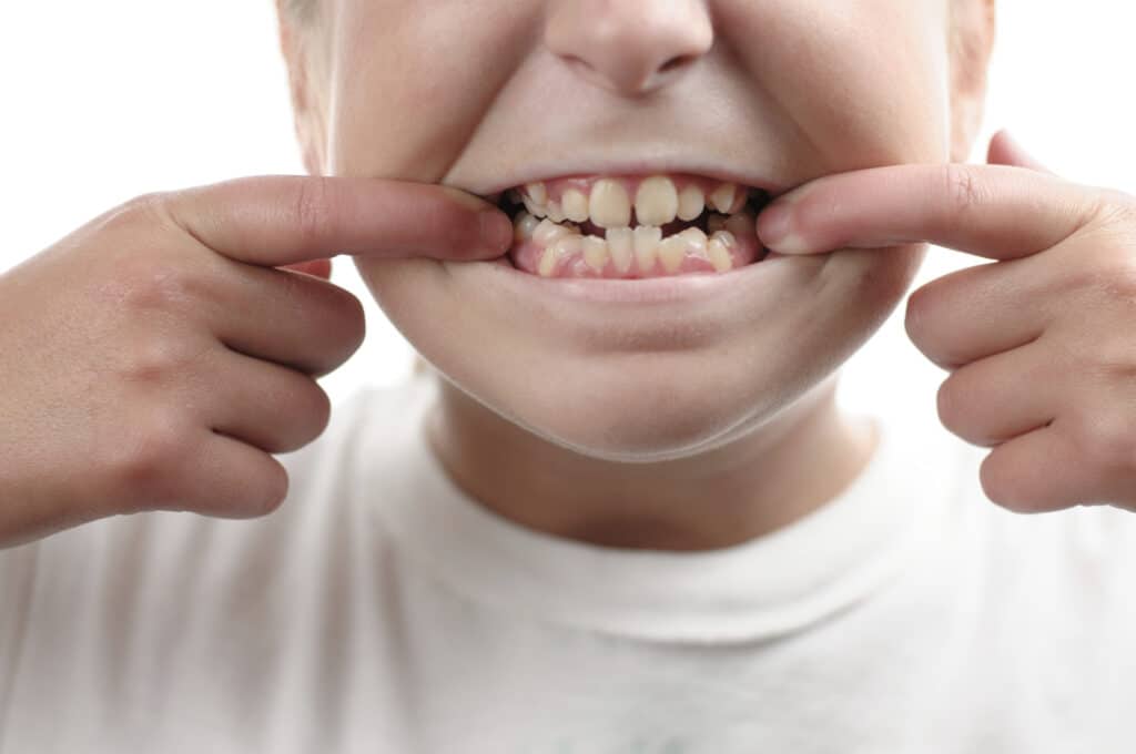 what to do if your child has extra teeth AKA hyperdontia