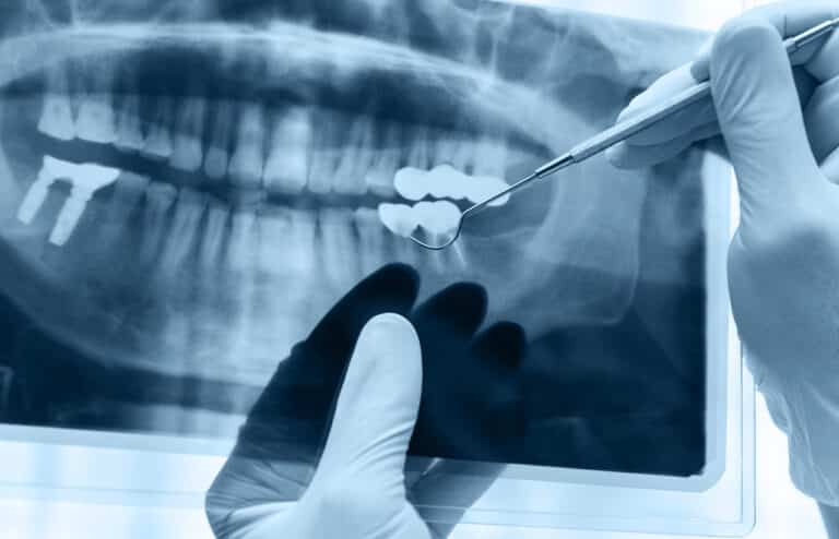 tooth extraction xray