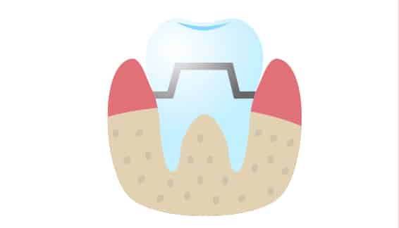 graphic displaying a mixed crown sitting in the gums and below the gum line