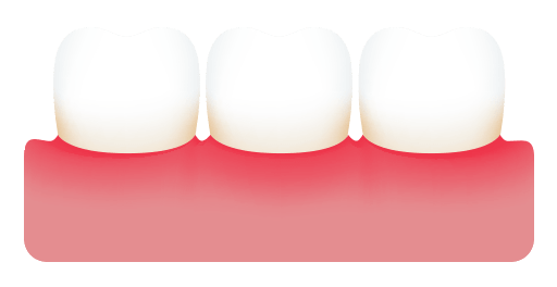 Periodontitis