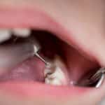symptoms of a cavity