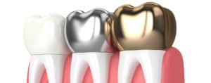 types of dental crowns include porcelain, ceramic, and metal