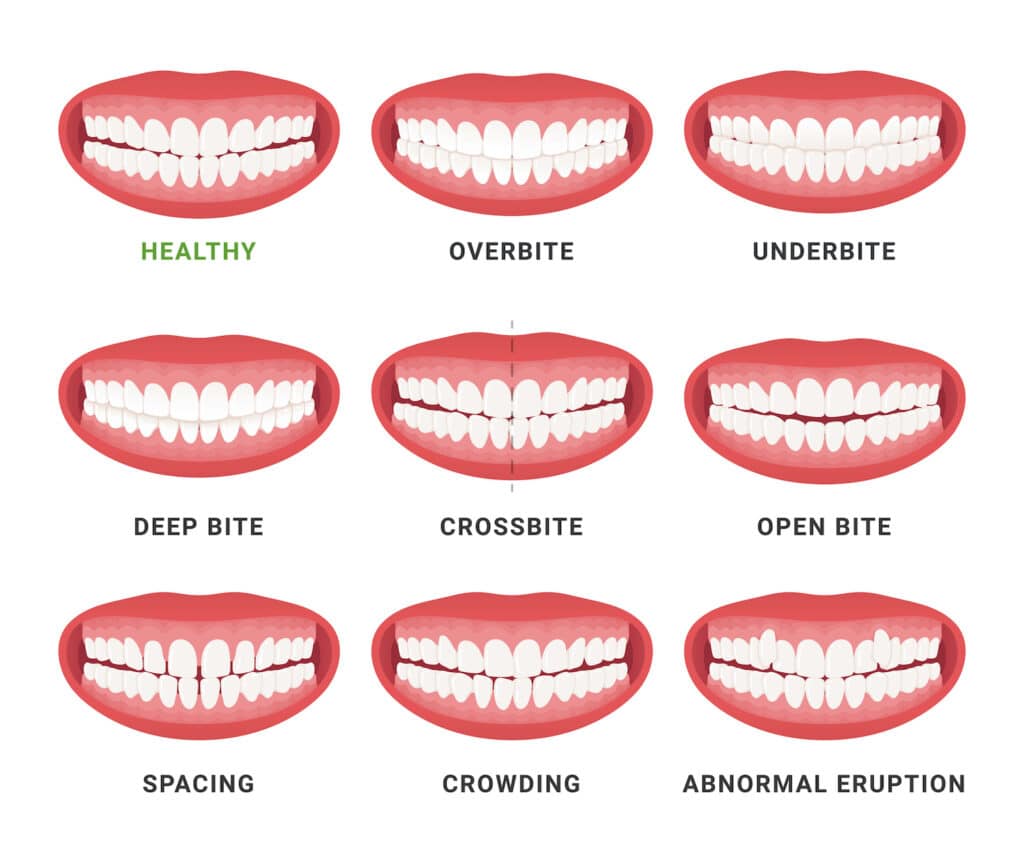 underbites compared to overbites